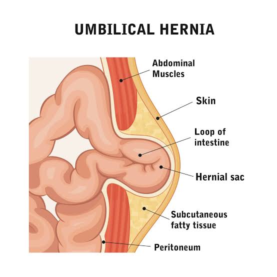 Para-umbilical Hernia