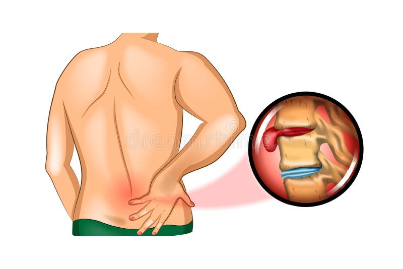 Lumbar Hernia