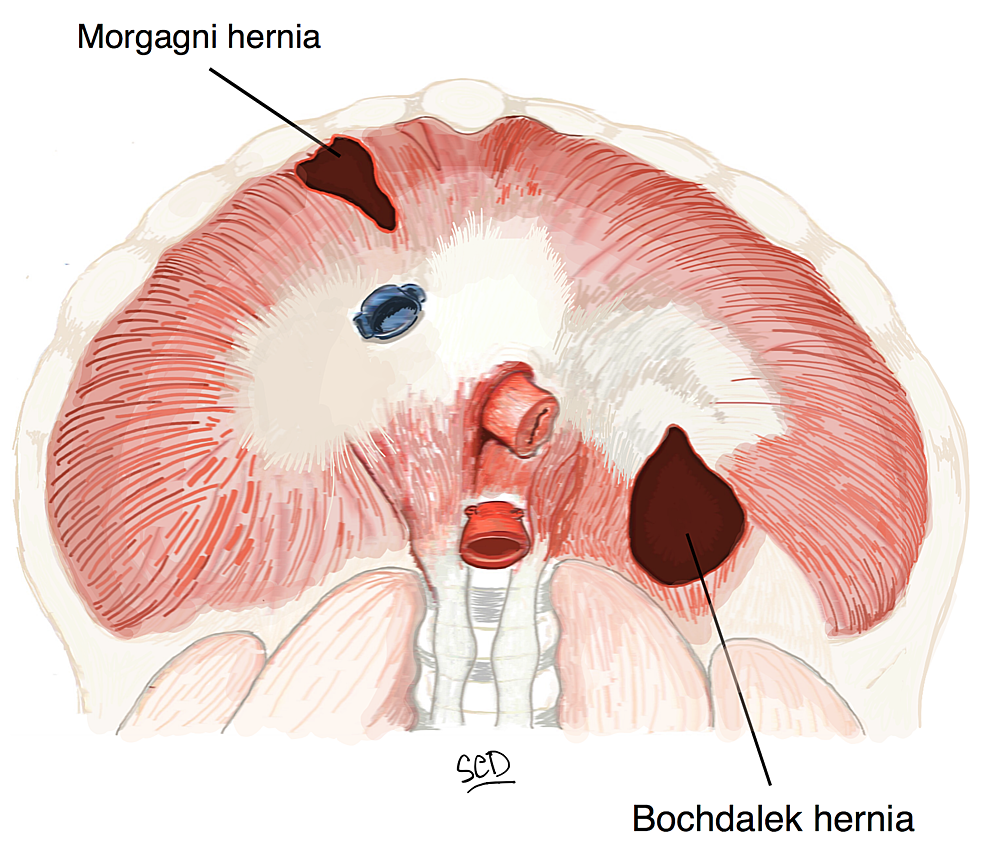 Diaphragmatic Hernia